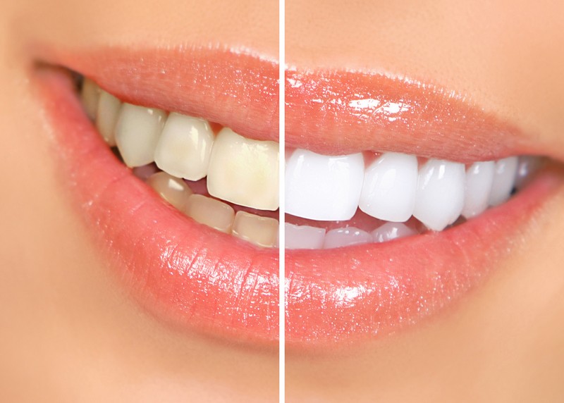 Teeth Whitening  Charlton, MA 
